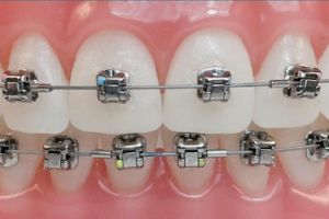 Ortodontik Tedaviye Başladığınızda Sizi Bekleyenler